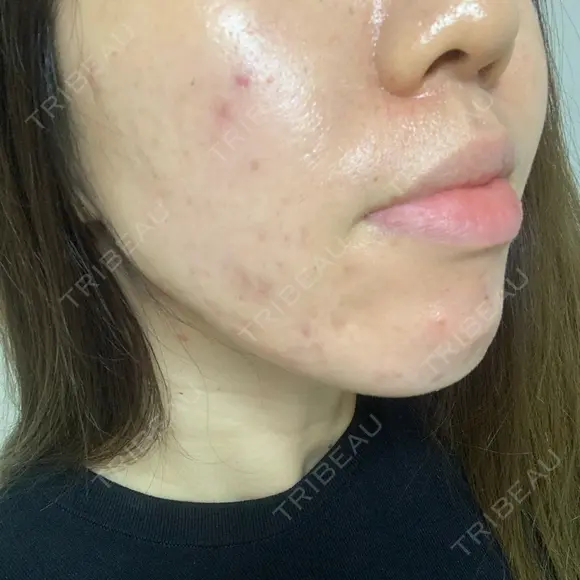 ニキビ治療 アサイクリニック 心斎橋本院 DAY 154 メイン用