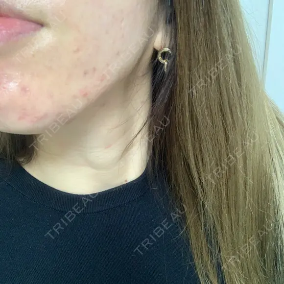 ニキビ治療 アサイクリニック 心斎橋本院 DAY 154 メイン用