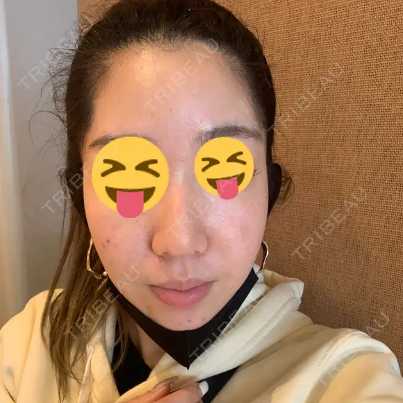 ヒアルロン酸注入（こめかみ） 湘南美容クリニック 京都院 DAY 0 メイン用