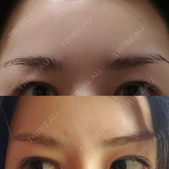 眉下切開 エイペックス美容外科 DAY 59 メイン用