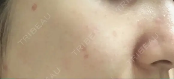 ほくろ・いぼ切除（肌） / ほくろ・いぼ除去レーザー（肌） 赤坂メディカルMクリニック AFTER メイン用