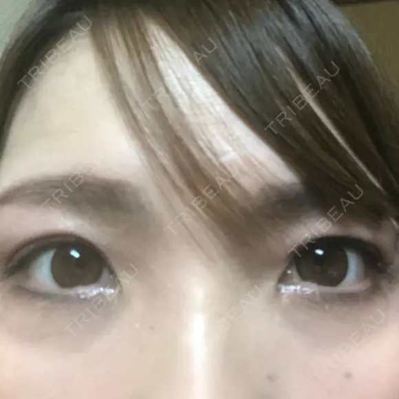 二重切開 / 眼瞼下垂（切開） / 上まぶたたるみ取り 湘南美容クリニック 高田馬場院 DAY 50 メイン用