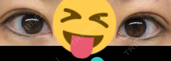 二重切開 湘南美容クリニック 藤沢院 DAY 23 メイン用