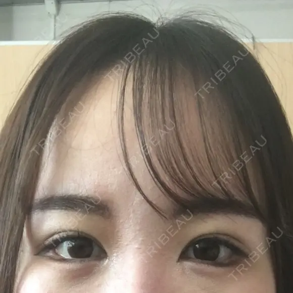 目尻切開 / タレ目形成・グラマラスライン（切開） B-LINE CLINIC 池袋院 DAY 11 メイン用
