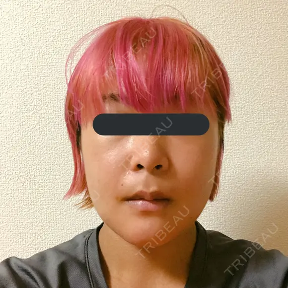 骨切り（あご） / 骨削り（頬） / ルフォー+ssro（両あご) リラ・クラニオフェイシャル・クリニック DAY 21 メイン用