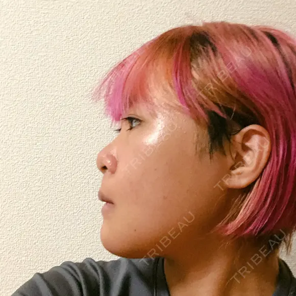 骨切り（あご） / 骨削り（頬） / ルフォー+ssro（両あご) リラ・クラニオフェイシャル・クリニック DAY 21 メイン用