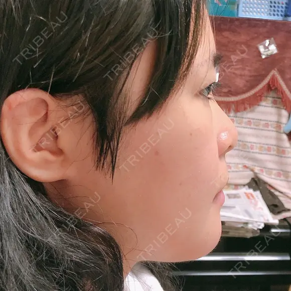 骨切り（あご） / 骨削り（頬） / ルフォー+ssro（両あご) リラ・クラニオフェイシャル・クリニック DAY 60 メイン用