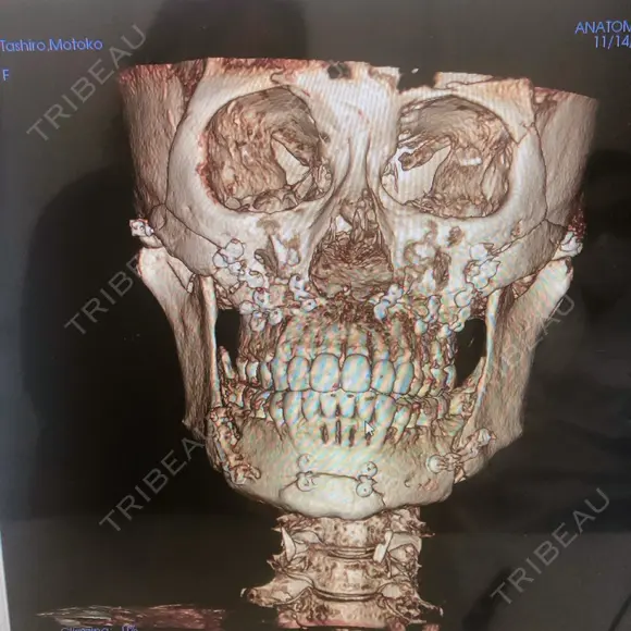 骨切り（あご） / 骨削り（頬） / ルフォー+ssro（両あご) リラ・クラニオフェイシャル・クリニック DAY 90 メイン用