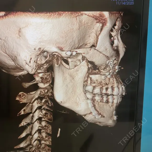 骨切り（あご） / 骨削り（頬） / ルフォー+ssro（両あご) リラ・クラニオフェイシャル・クリニック DAY 90 メイン用