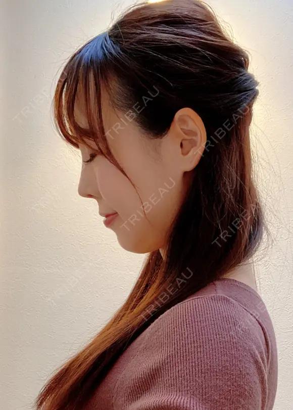 鼻尖形成（切開） / 鼻中隔延長（切開） / 軟骨移植 / ワシ鼻修正・ハンプ切除 / 真皮移植 湘南美容クリニック 上野院 DAY 18 メイン用