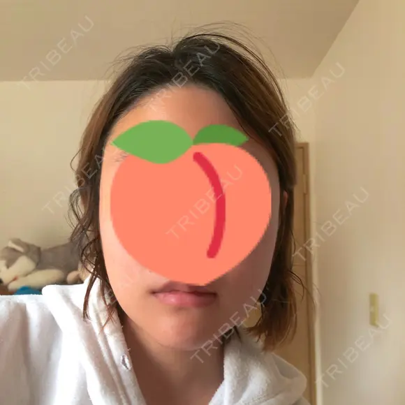 骨切り（あご） / 骨削り（頬） / ルフォー+ssro（両あご) リラ・クラニオフェイシャル・クリニック DAY 159 メイン用