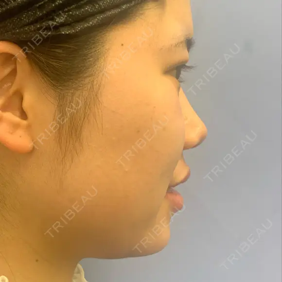 ボトックス（エラ・小顔） / 脂肪溶解注射（顔） 湘南美容クリニック 宇都宮院 DAY 0 メイン用