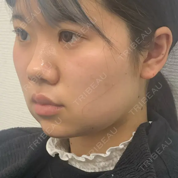 ボトックス（エラ・小顔） / 脂肪溶解注射（顔） 湘南美容クリニック 宇都宮院 DAY 0 メイン用