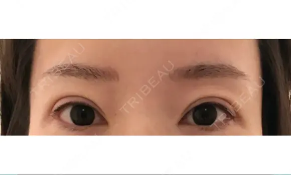 アートメイク（眉） GRACIA clinic 【グラシアクリニック】 DAY 28 メイン用