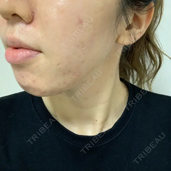 ニキビ治療 アサイクリニック 心斎橋本院 DAY 164 メイン用