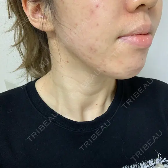 ニキビ治療 アサイクリニック 心斎橋本院 DAY 164 メイン用