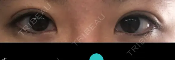 二重切開 湘南美容クリニック 藤沢院 DAY 29 メイン用