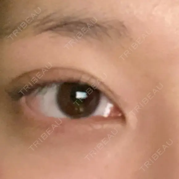 二重埋没 R Beauty CLINIC 銀座院 DAY 3 メイン用