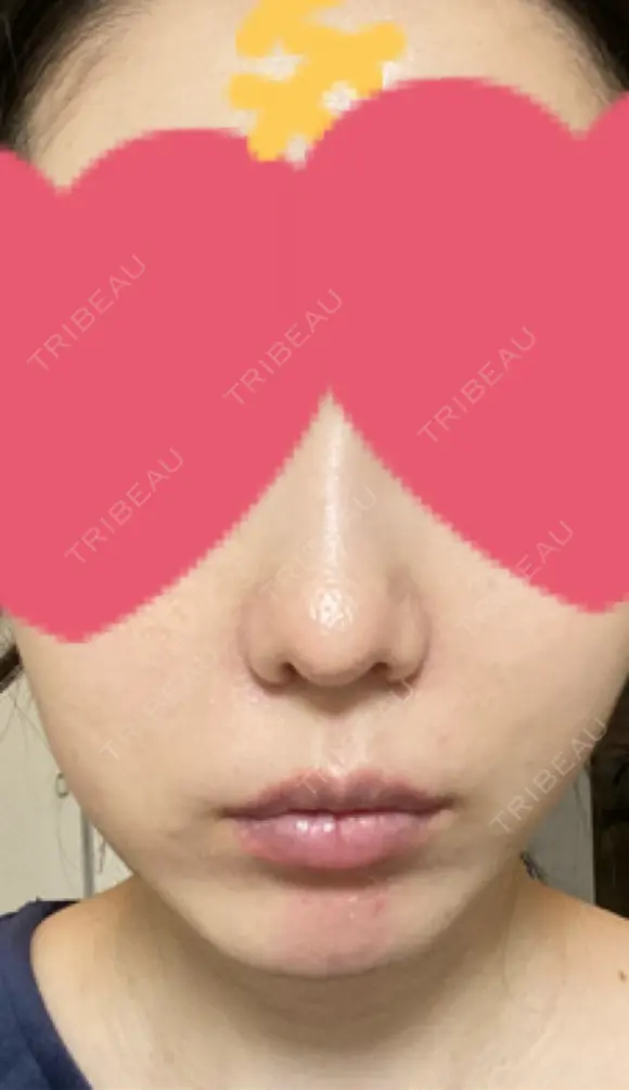 小鼻縮小（切開） / 鼻翼基部形成（貴族手術） 新宿ラクル美容外科クリニック 新宿院 DAY 29 メイン用