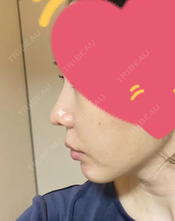 小鼻縮小（切開） / 鼻翼基部形成（貴族手術） 新宿ラクル美容外科クリニック 新宿院 DAY 29 メイン用