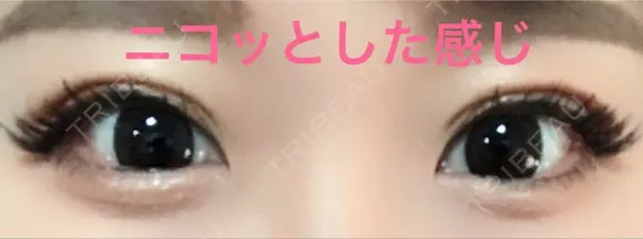 二重埋没 湘南美容クリニック 松山院 DAY 24 メイン用