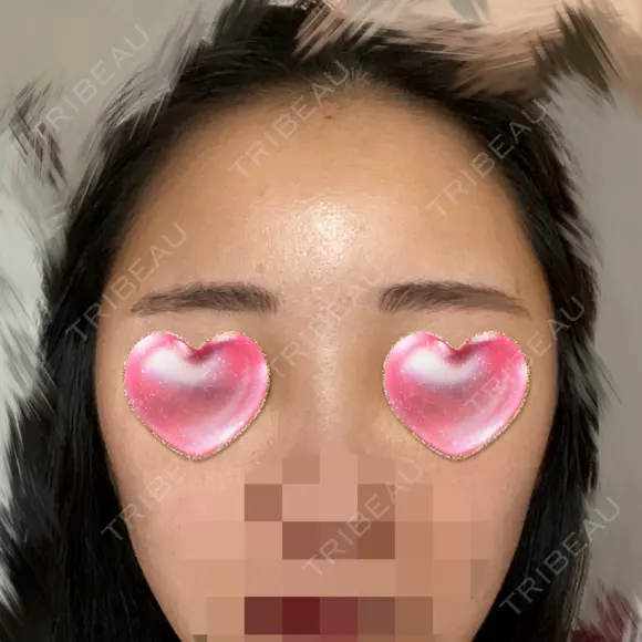 額を丸く / 脂肪注入（肌） / 脂肪注入（額） ヴェルトラクリニック 大阪院 DAY 4 メイン用