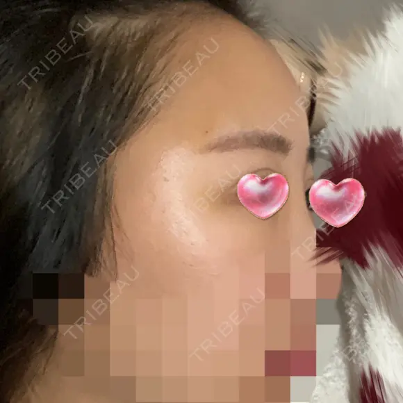 額を丸く / 脂肪注入（肌） / 脂肪注入（額） ヴェルトラクリニック 大阪院 DAY 4 メイン用