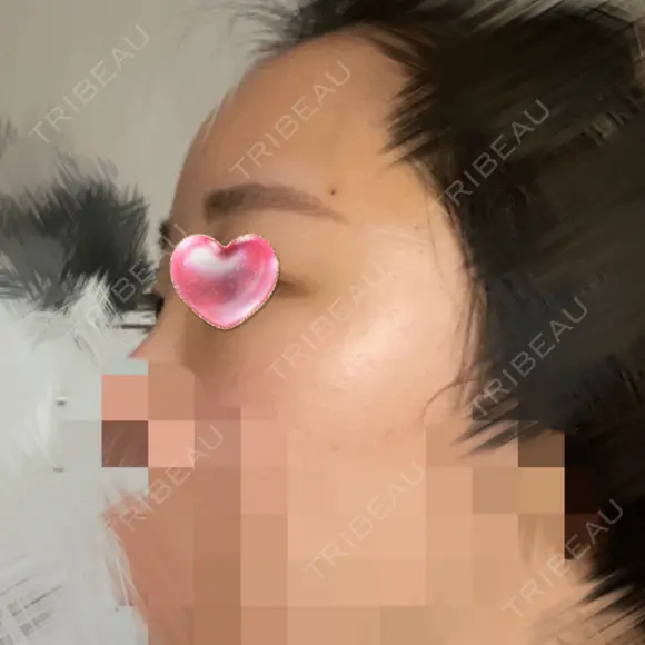 額を丸く / 脂肪注入（肌） / 脂肪注入（額） ヴェルトラクリニック 大阪院 DAY 4 メイン用