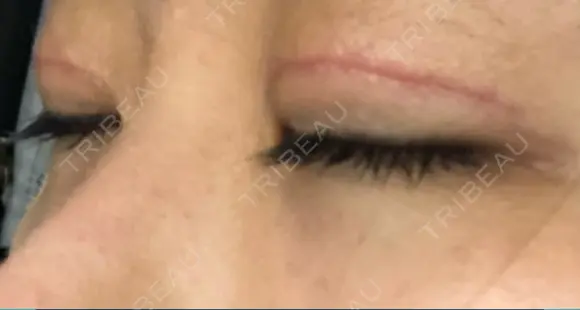 二重切開 湘南美容クリニック 藤沢院 DAY 30 メイン用