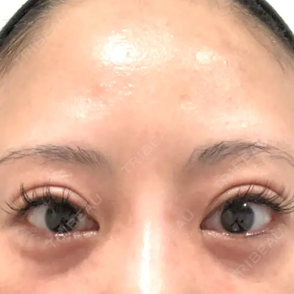 二重切開 BIANCA銀座 AFTER メイン用