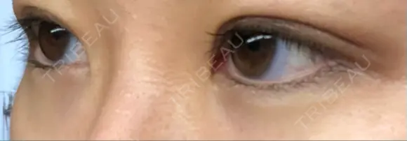 二重切開 湘南美容クリニック 藤沢院 DAY 31 メイン用