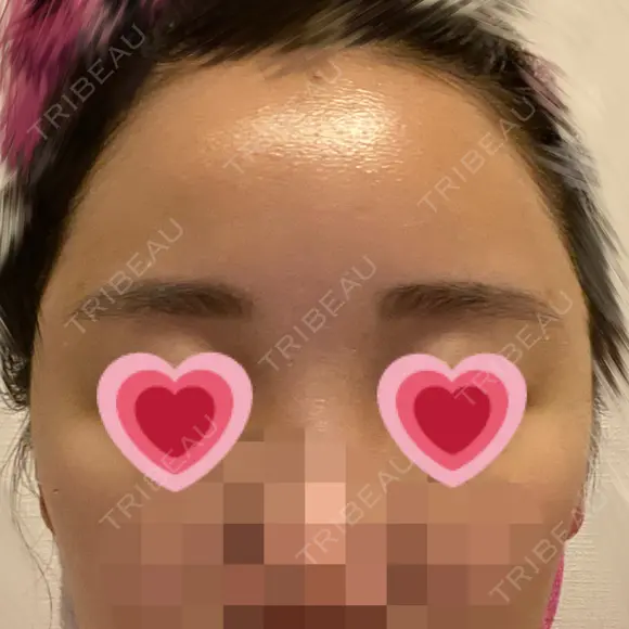 額を丸く / 脂肪注入（肌） / 脂肪注入（額） ヴェルトラクリニック 大阪院 DAY 6 メイン用