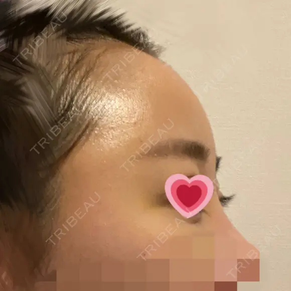 額を丸く / 脂肪注入（肌） / 脂肪注入（額） ヴェルトラクリニック 大阪院 DAY 6 メイン用