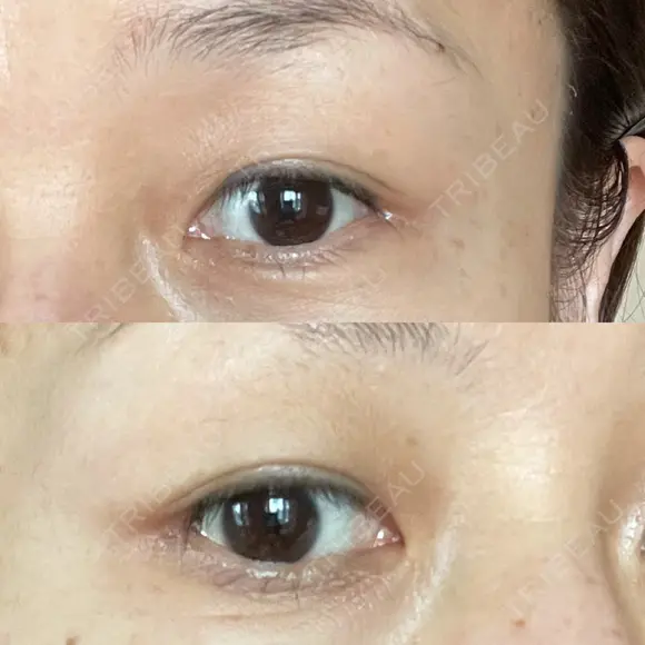 眼瞼下垂（切開） 湘南美容クリニック 秋葉原院 DAY 44 メイン用