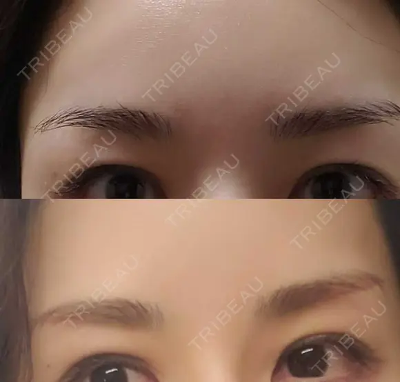 眉下切開 エイペックス美容外科 AFTER メイン用