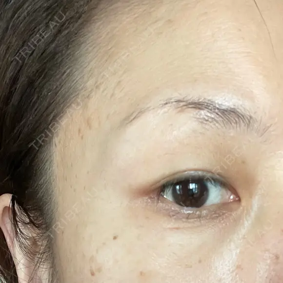 目尻切開 湘南美容クリニック 秋葉原院 AFTER メイン用