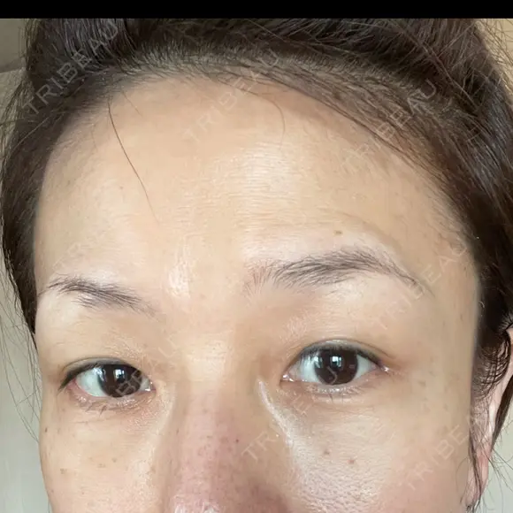 目尻切開 湘南美容クリニック 秋葉原院 DAY 86 メイン用