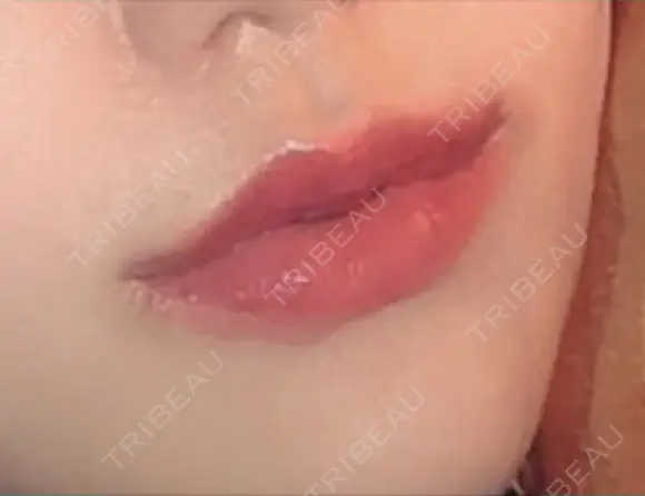 口唇縮小術 / 口角挙上 B-LINE CLINIC 池袋院 DAY 29 メイン用