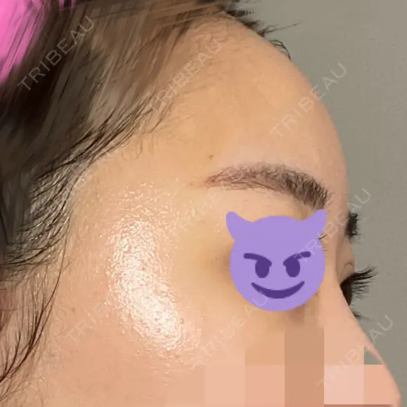 額を丸く / 脂肪注入（肌） / 脂肪注入（額） ヴェルトラクリニック 大阪院 DAY 7 メイン用