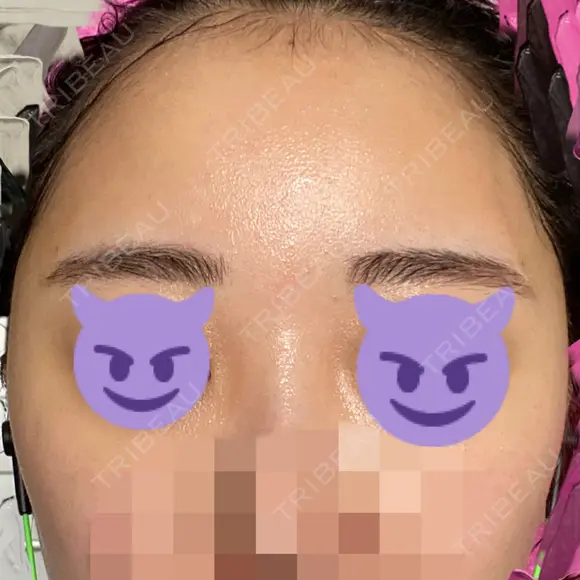 額を丸く / 脂肪注入（肌） / 脂肪注入（額） ヴェルトラクリニック 大阪院 AFTER メイン用
