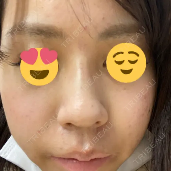 ヒアルロン酸注入（鼻） アクトリー勝どきウェルネスメディカルクリニック DAY 1 メイン用