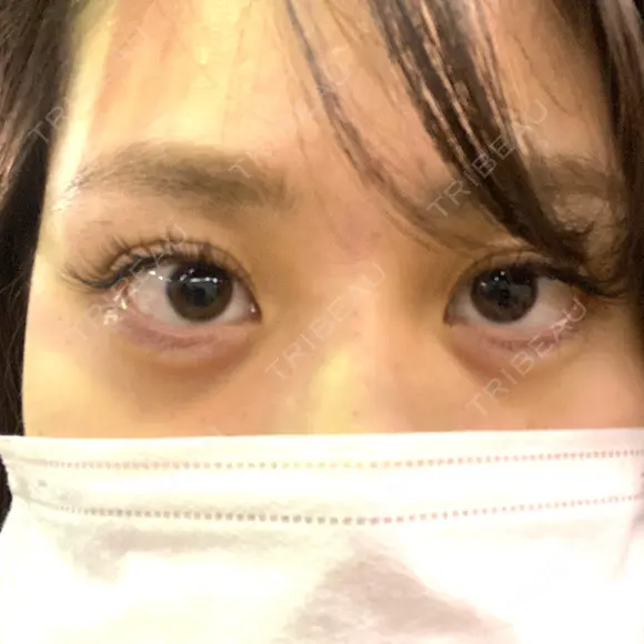 ヒアルロン酸注入（涙袋） フィラークリニック 新宿院 DAY 0 メイン用