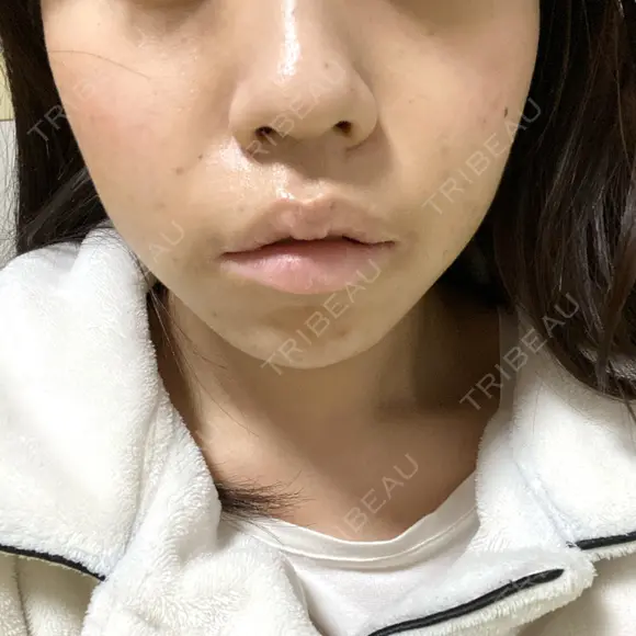 ヒアルロン酸注入（涙袋） フィラークリニック 新宿院 DAY 0 メイン用