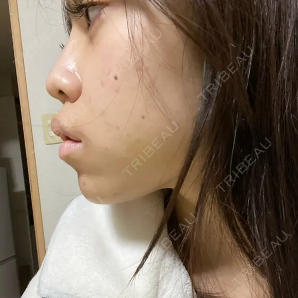 ヒアルロン酸注入（鼻） アクトリー勝どきウェルネスメディカルクリニック DAY 1 メイン用
