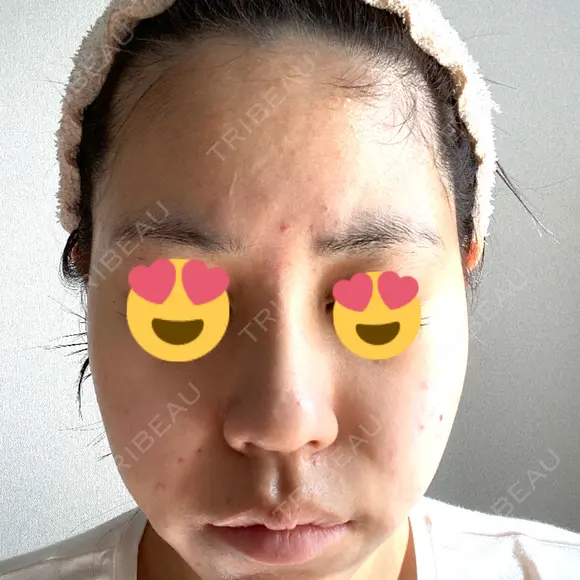 ヒアルロン酸注入（鼻） アクトリー勝どきウェルネスメディカルクリニック DAY 2 メイン用