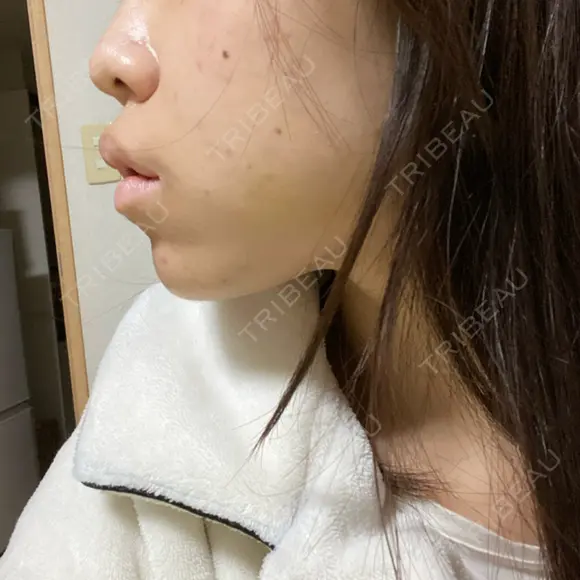 ボトックス（あご） / ヒアルロン酸注入（あご） フィラークリニック 新宿院 DAY 0 メイン用