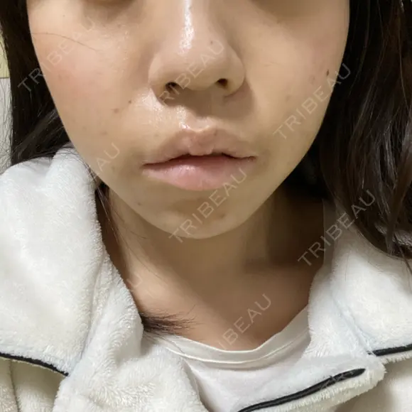ボトックス（あご） / ヒアルロン酸注入（あご） フィラークリニック 新宿院 DAY 0 メイン用