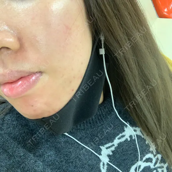 ニキビ治療 アサイクリニック 心斎橋本院 AFTER メイン用