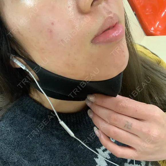 ニキビ治療 アサイクリニック 心斎橋本院 DAY 172 メイン用