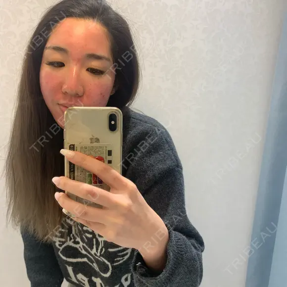 ピーリング（ニキビ・毛穴） / ダーマペン TRUE DESIGN CLINIC DAY 0 メイン用